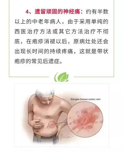 带状疱疹后遗症疼的厉害怎么办?有一种中蒙医疗法助您快速摆脱痛苦!