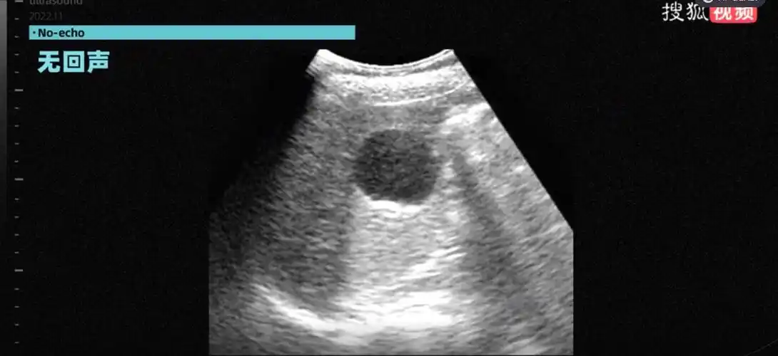 b超"回声"大揭秘:胆结石是怎么被发现的?_超声_图像_反射