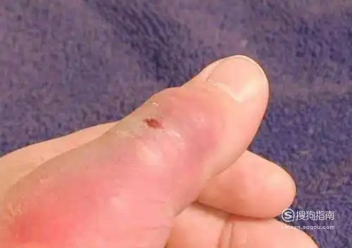 被蝎子蛰到怎么办