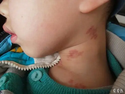 小儿(5岁)带状疱疹 - 皮肤及性传播疾病讨论版 - 爱爱医医学论坛