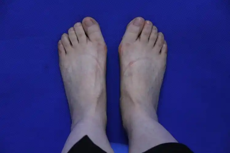 大脚骨(拇指外翻)107天感受怎么样?风险和并发症/后遗症?