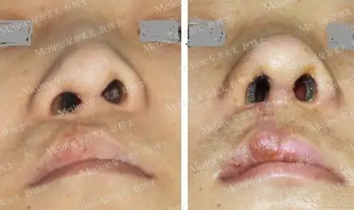 【讨论】请各位老师看下这个先天性鼻畸形 [病例帖]