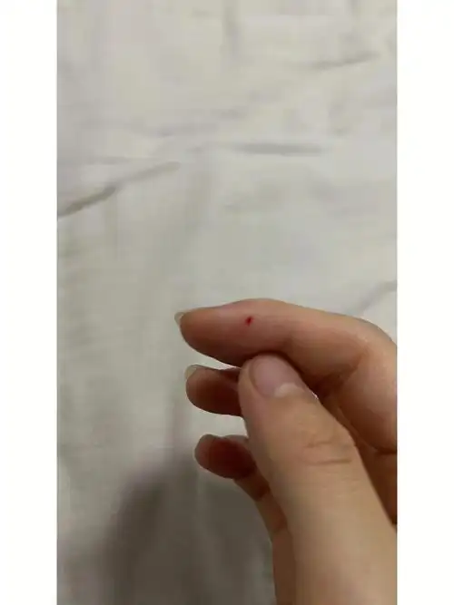 被三个月不到的小猫咬伤出血