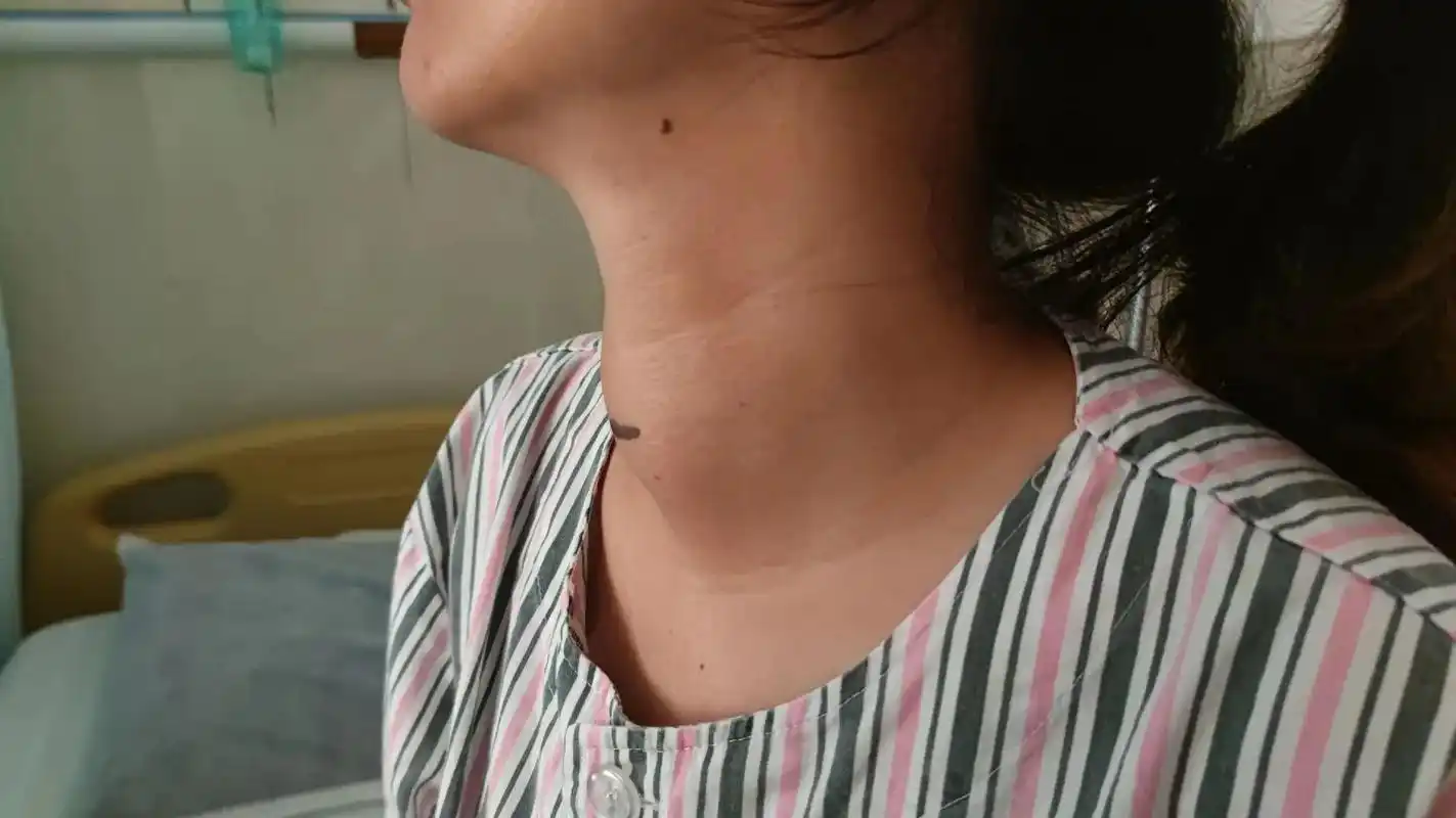 脖子肿需警惕是否甲状腺问题 #有一种疼叫做看着都疼 #医院  - 抖音