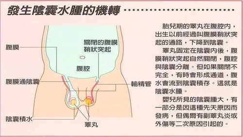 【肚脐异常与阴囊水肿abnormal navel & hydrocele testis】肚脐突出
