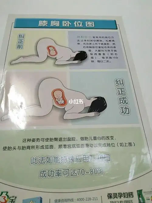 臀位转头位只需要一天