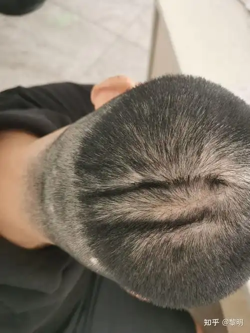 头皮凹凸了 - 知乎