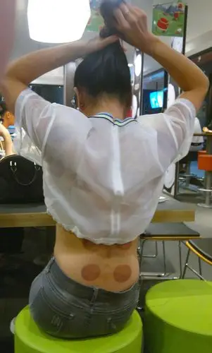 拔罐女生 - 手机类-摄影大赛2016 - 国家地理中文网