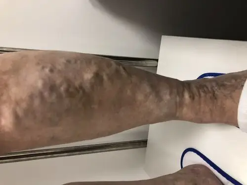 下肢水肿勿忘心源性