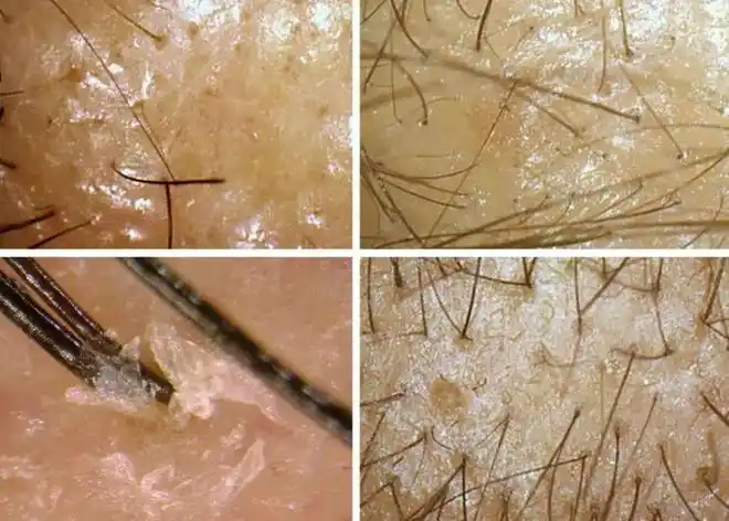 简单地说,毛囊检测就是借助电子显微放大设备将肉眼无法看到的头发