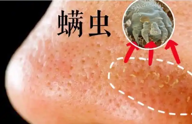 鼻子上的黑头严重,两个方法教你去除,开学美美回学校