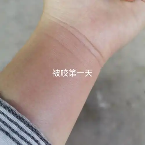 被红火蚁咬了涂这个消肿消痒