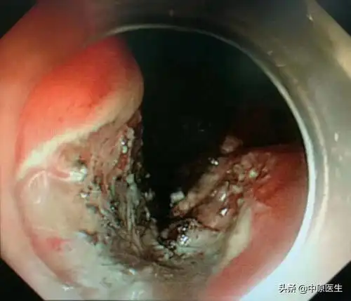 刀下留人结果70岁贲门癌患者专家力主保留贲门复查正常