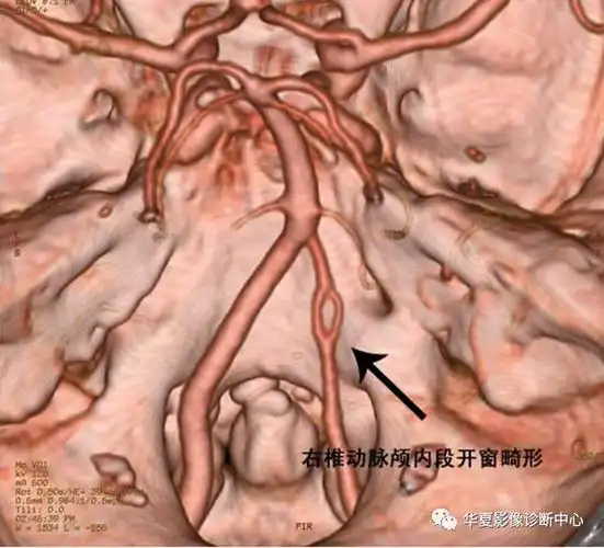 头颈部动脉开窗畸形