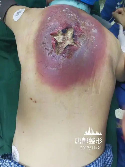 蜂窝组织炎_治疗