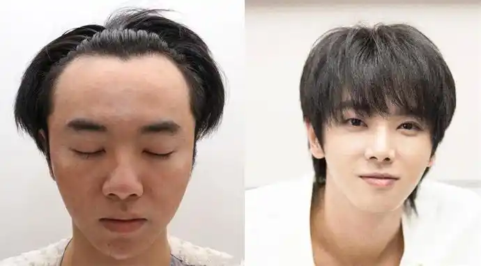 华晨宇声明意外透漏的细节:否认整容植发,承认图片是华晨宇本人_腾讯