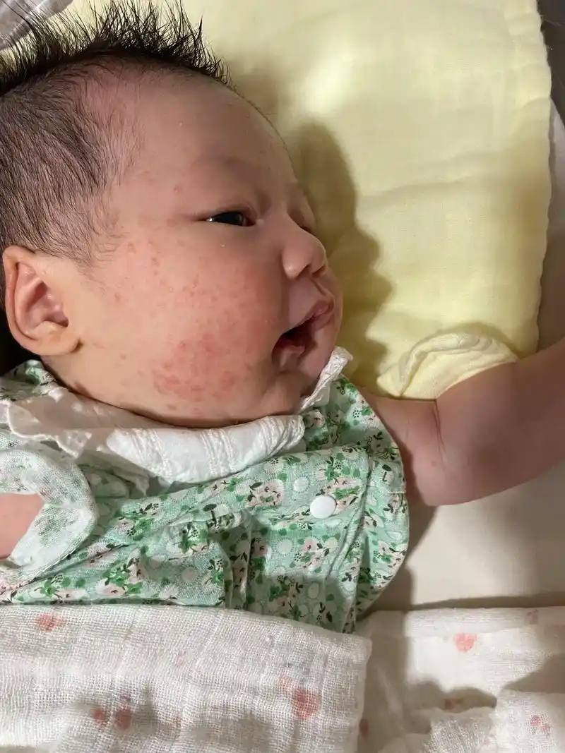 今天是严重爆发新生儿痤疮的第二天,脸上特别特别严 - 抖音