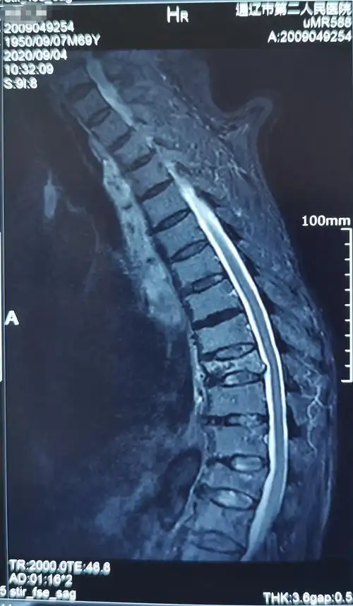 71岁胸9压缩性骨折椎体成型手术一例