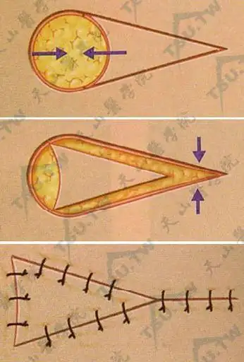 皮肤带蒂移植:皮瓣设计与局部皮瓣转移修复术