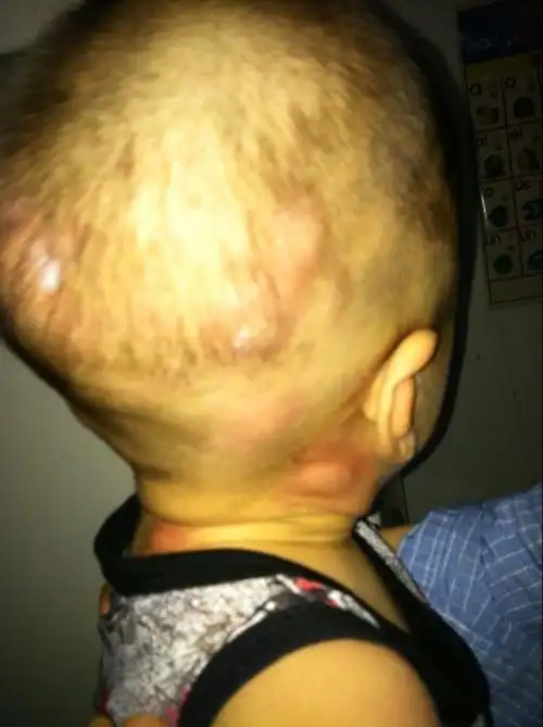 11个月的宝宝头上莫名起了很多大包包