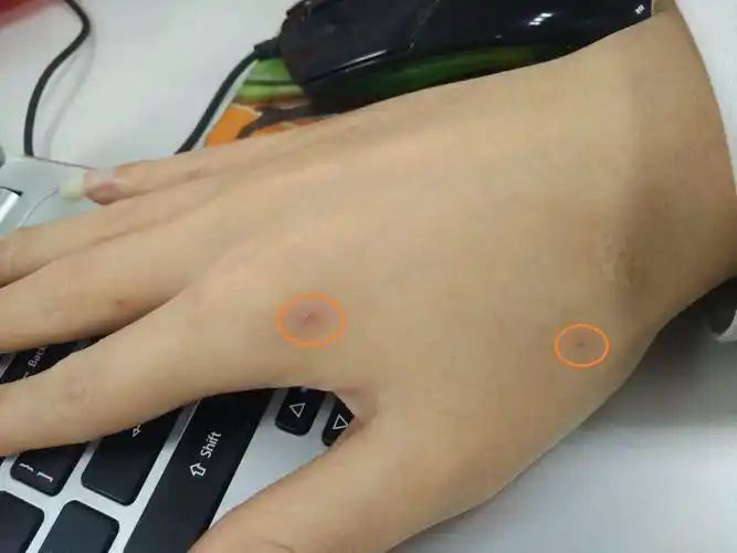 手背红色小点什么原因
