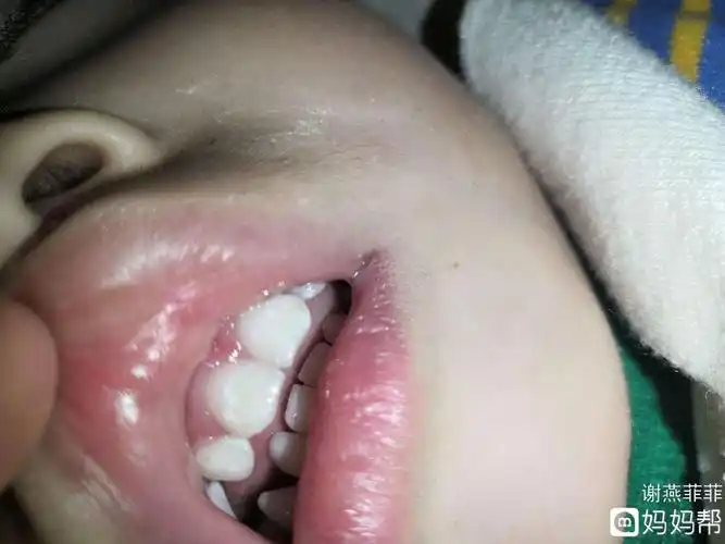 儿童脱矿的牙齿图片 儿童脱矿的牙齿能恢复吗?-图片大观-奇异网