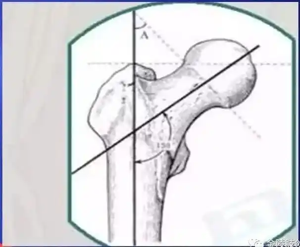 汇总丨骨科常用的角度测量方法