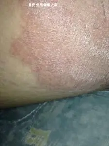 睾丸皮痒男人下面蛋蛋皮肤痒维生去鸡皮复方利卡多因软膏脸部红