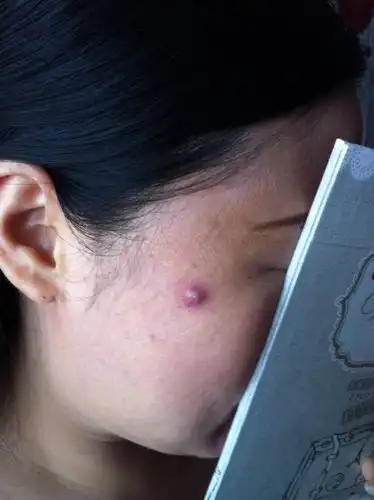 来自新郑市妇幼保健院 答: 希望各个医生能分析我的病情 你这是小疖肿