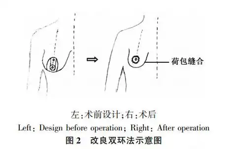 隆胸科普产后乳房下垂做自体脂肪隆胸好还是假体隆胸好
