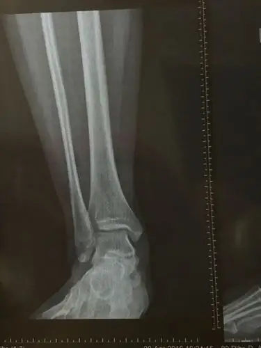 右脚脚踝内侧有一块骨头突出 很小的时候崴过一次 最近开始偶尔有点疼