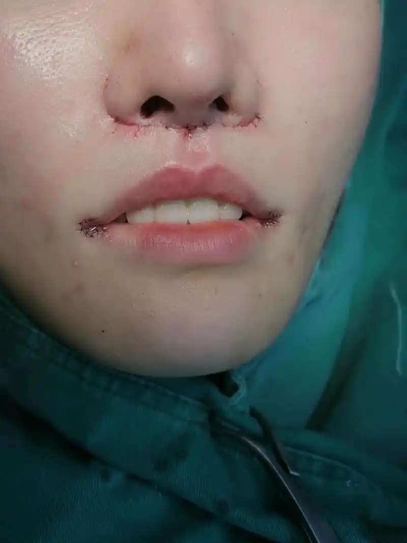 人中缩短 嘴角上扬术后第一天记录