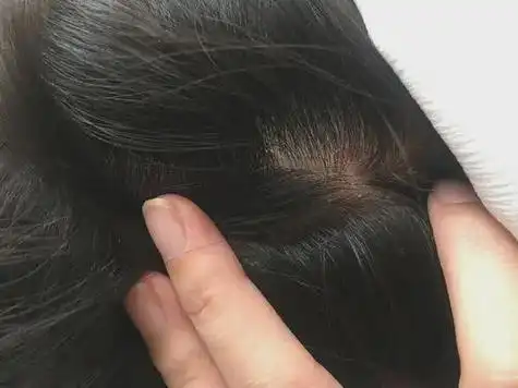 了解头皮了解健康