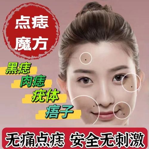 【日本药材】正品点痣膏药水脸部祛黑痣肉痣痦子去痣膏