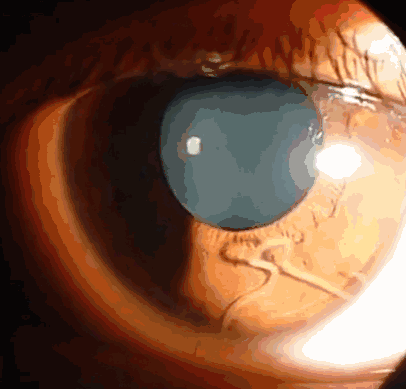 80后少女脑部惊现数百寄生虫!就因为12年前吃过呢样嘢