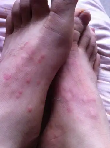 冬季皮肤过敏图片及症状