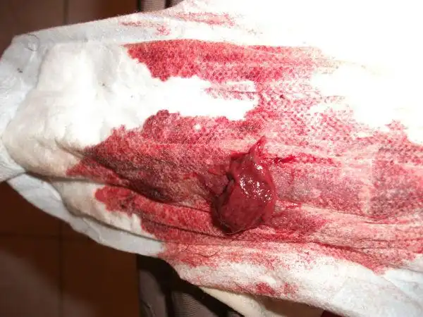 来月经有个大血块怎么回事