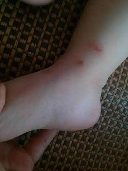 两周岁男宝宝,不知道被什么虫子咬了,刚开始就跟蚊子咬了一样过后就