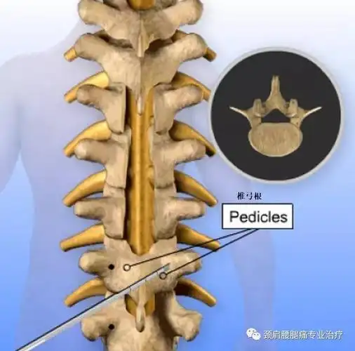 中英文字幕胸椎椎板切除内固定术
