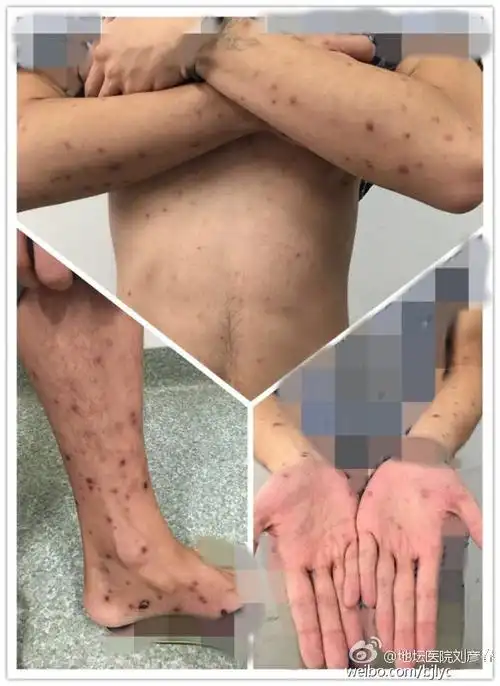 抗生素滥用对性病的治疗有什么影响?