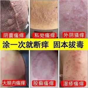 阴囊瘙痒去潮湿肛门私处瘙痒毛壤炎睾丸痒膏冰霜男士私处止痒神器