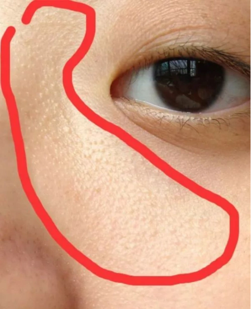 眼睛周围长的肉疙瘩是什么