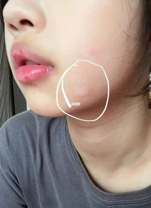 白癜风还是白色糠疹