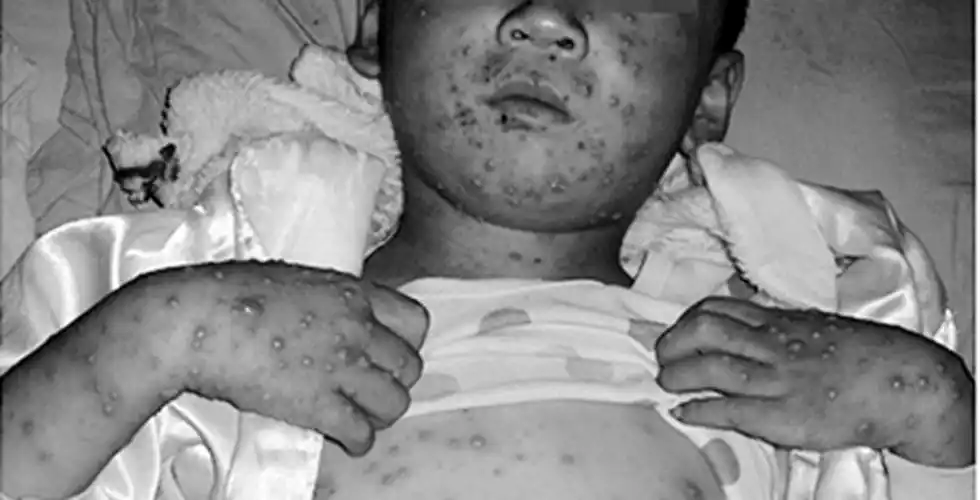 天花感染危害的图片