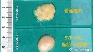 脂肪胶和自体脂肪的区别