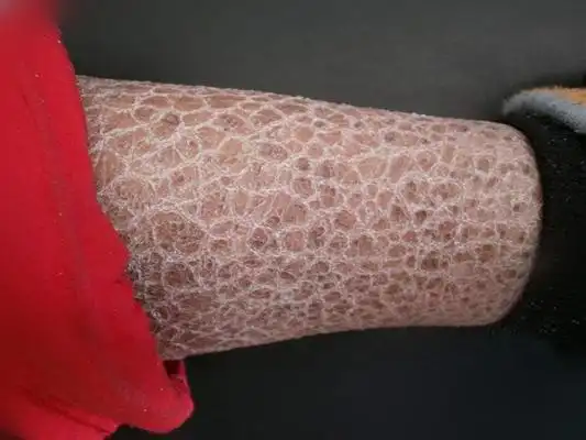 鱼鳞皮肤病 (32)