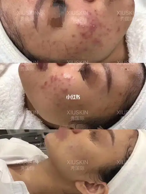 痘肌 问题性肌肤联合治疗_痘肌_皮肤管理_痘痘肌_痘坑_粉刺_痘印_痘痘