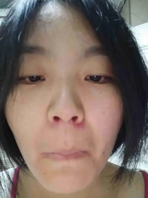 感冒了过后鼻子两侧就开始开裂,截止到现在,半年多了反反复复,好几天