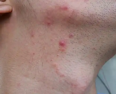 血热的症状痘痘图片8