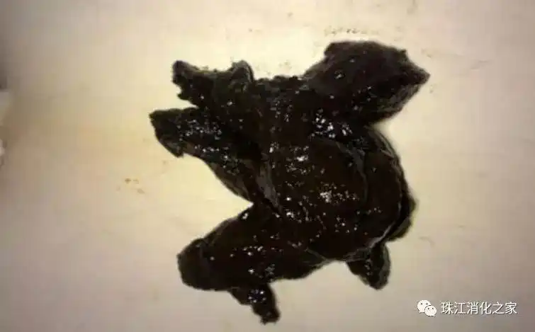 漫谈消化道出血之黑便:为什么我的大便变黑了?